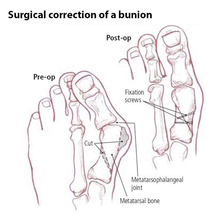 Surgery Bunion Recovery Problems Weight Loss