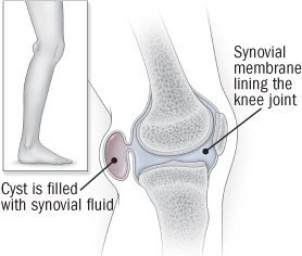 illustrazione dell'articolazione del ginocchio che mostra la cisti di Baker's cyst