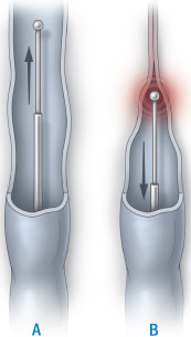 illustration af endovenøs behandling med laser