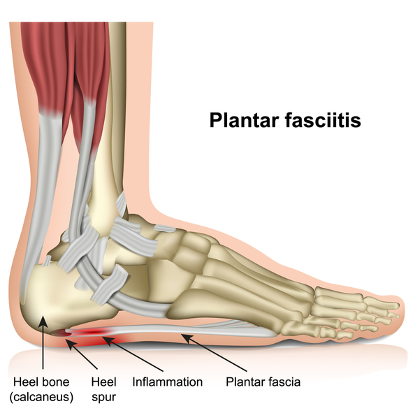signs of planters fasciitis