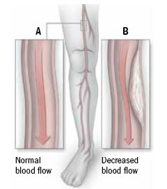 PAD It is a pain in the leg - Harvard Health