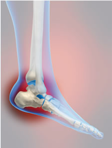 common cause of heel pain 