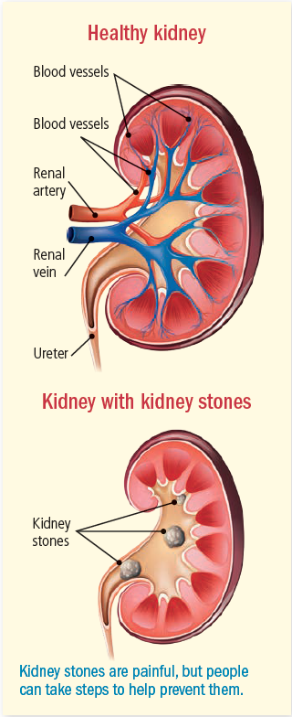 kidney stone pain relief