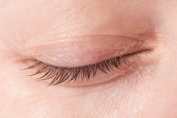 The Aging Eye When To Worry About Eyelid Problems Harvard Health