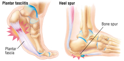 what causes sore heels