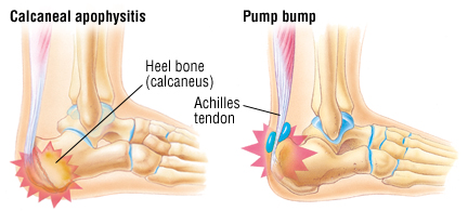 pain in heel of foot when walking