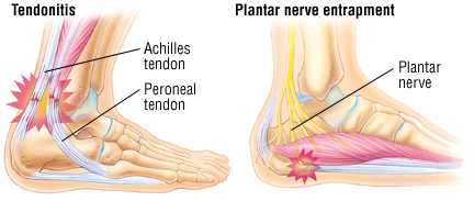 severe pain in heels