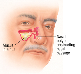 allergic nasal polyp