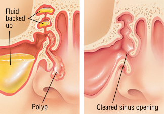 infected nasal polyp