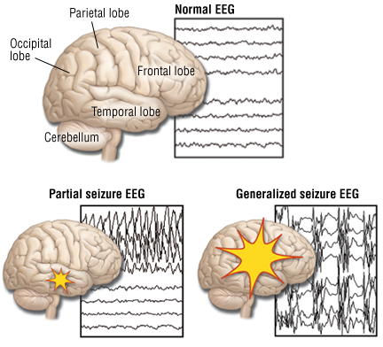 Epilepsy Harvard Health