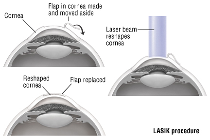 Lasik Harvard Health