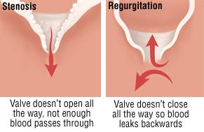 Heart Valve Problems Harvard Health