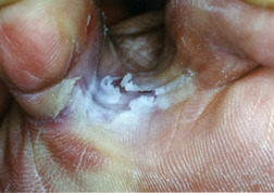split skin between little toe