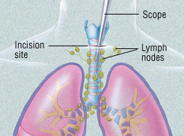 Squamous Cell Carcinoma Of The Lung Harvard Health