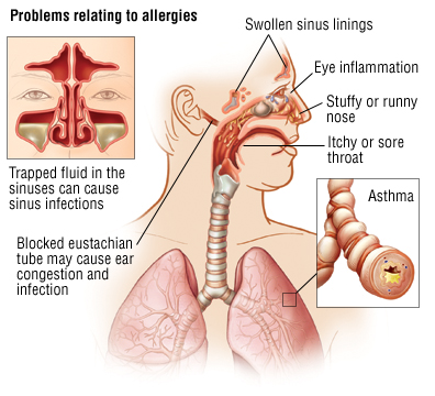 Allergy Overview Harvard Health