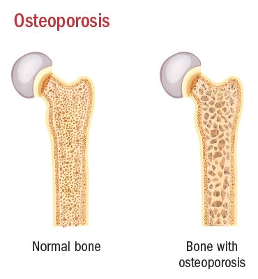 Boning up on osteoporosis - Harvard Health