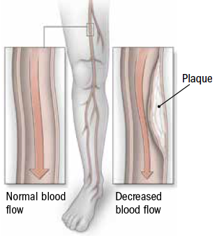 peripheral artery disease symptoms