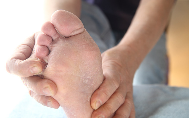 skin fissure under toes