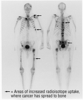 Bone Scan Harvard Health