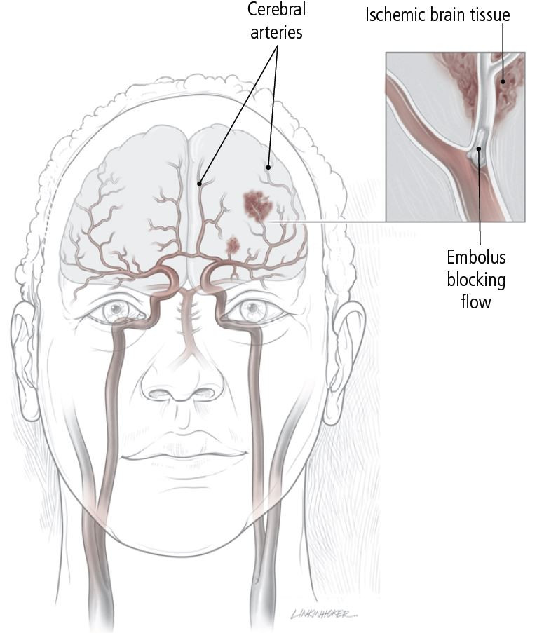 stroke-overview-harvard-health