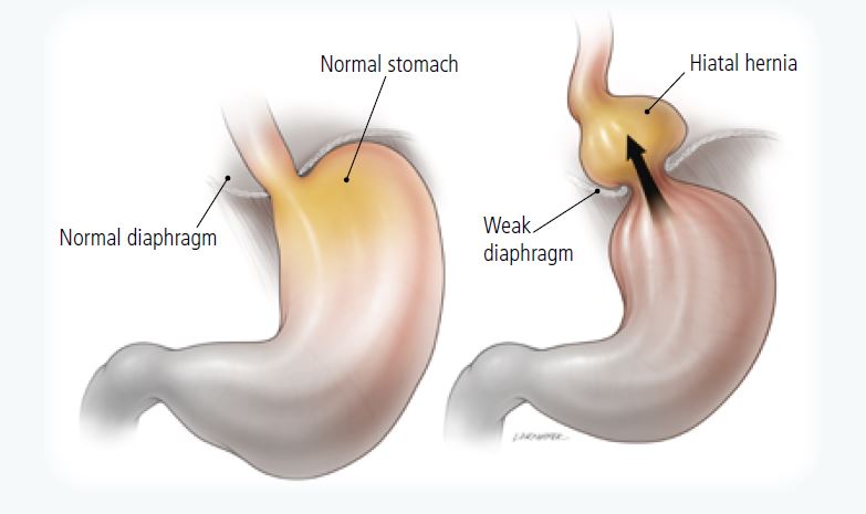 Gastroesophageal Reflux Disease GERD Harvard Health