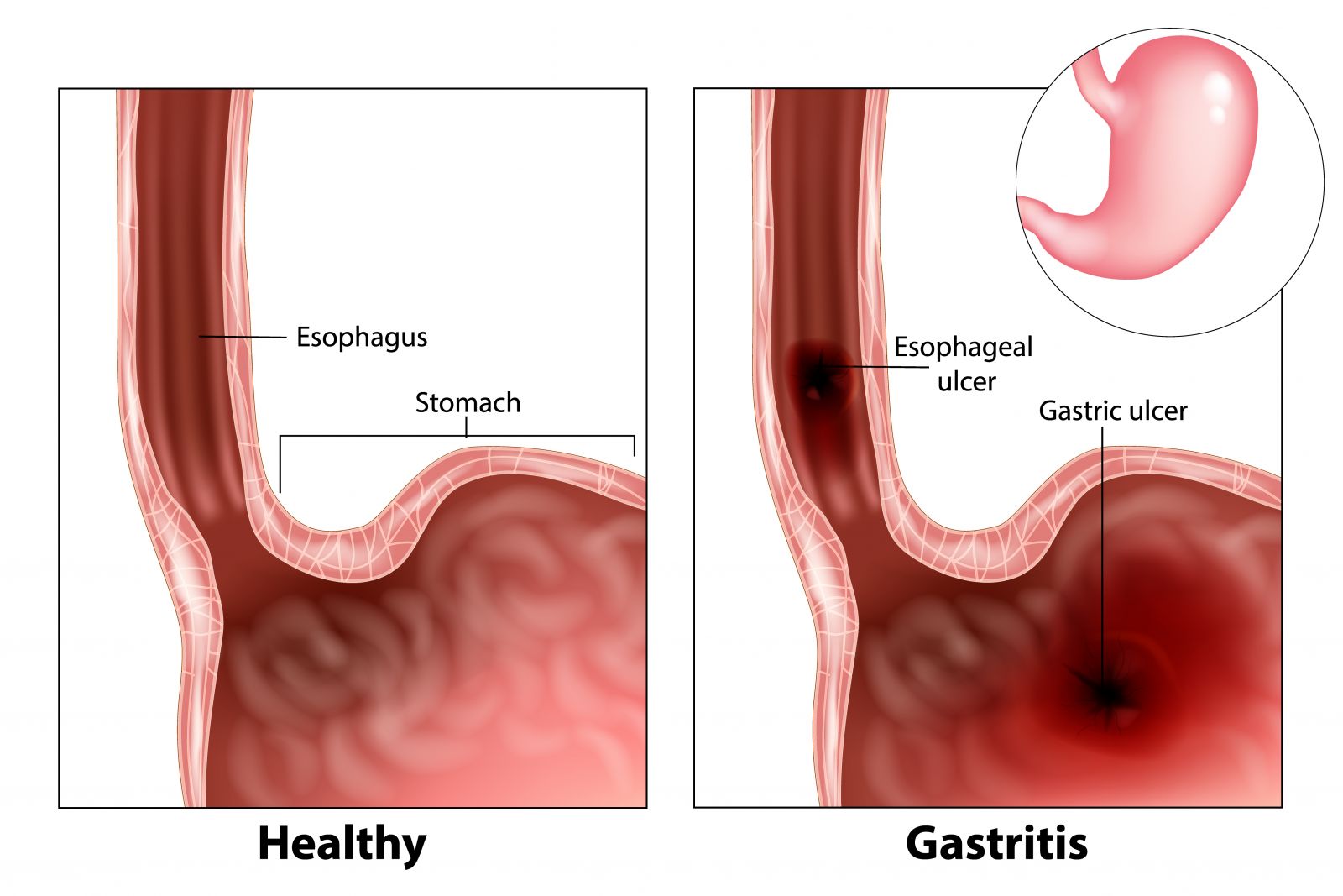 Gastritis Harvard Health