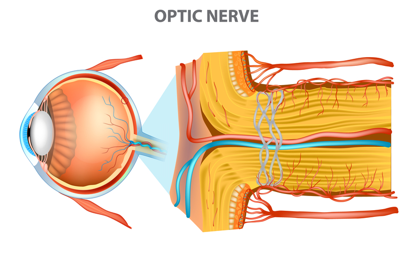 Optic Nerve Swelling Papilledema Harvard Health