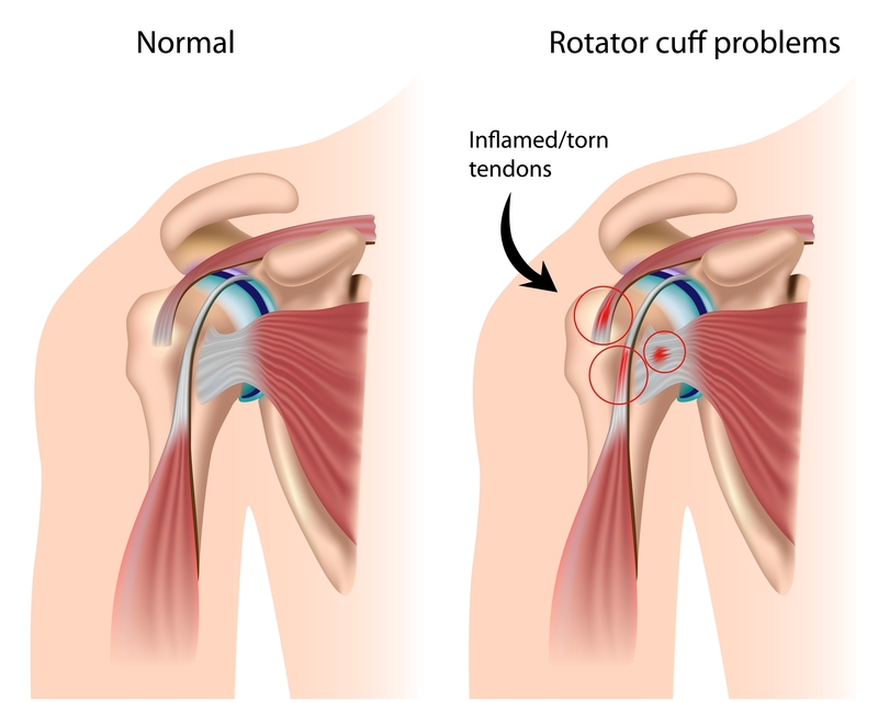 rotator cuff symptoms treatment