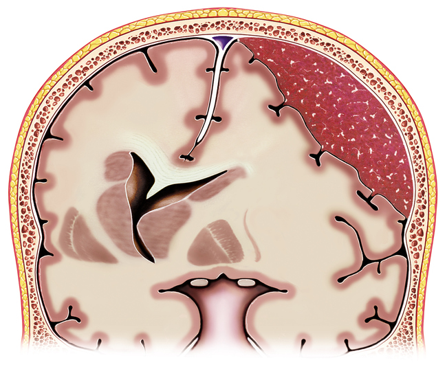 Acute Subdural Hematoma The Neurosurgical Atlas Porn Sex Picture