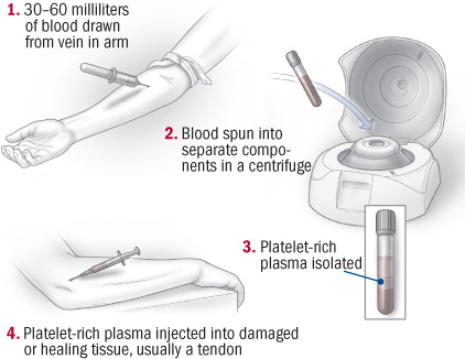 Platelet Rich Plasma Therapy Harvard Health